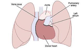双语笑话 第29期:Heart Transplant心脏移植2.jpg