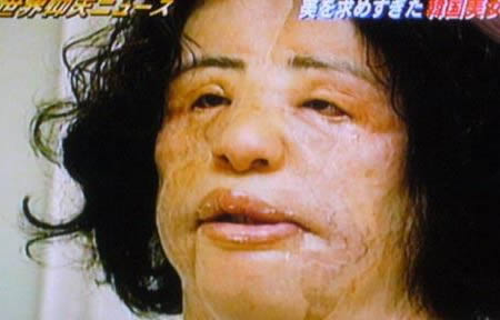 韩苗可：一个注射食用油到自己脸上的韩国整容上瘾者