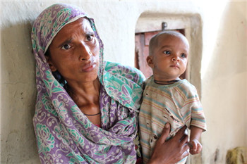 Why hundreds of millions of Indian children are malnourished.jpg