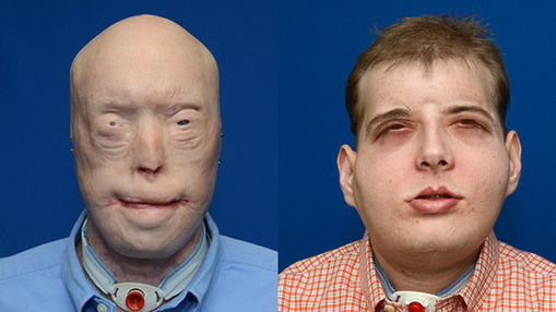 史上最大面积脸部移植手术让被火毁容消防员重生.jpg