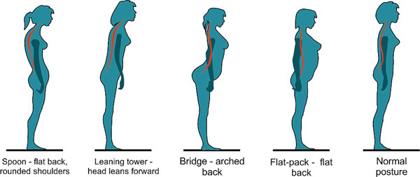 Standing posture determines back pain or not: Are you "spoon-shaped" or "bridge-shaped"?.jpg