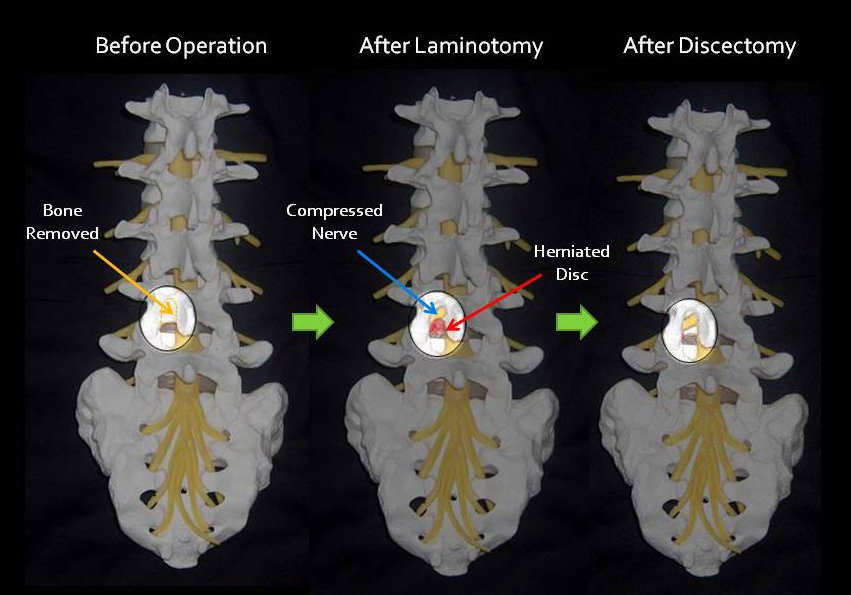 microdiscectomy.jpg