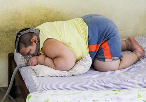 A boy from abroad weighs nearly 160 kg. Child obesity is a problem.jpg
