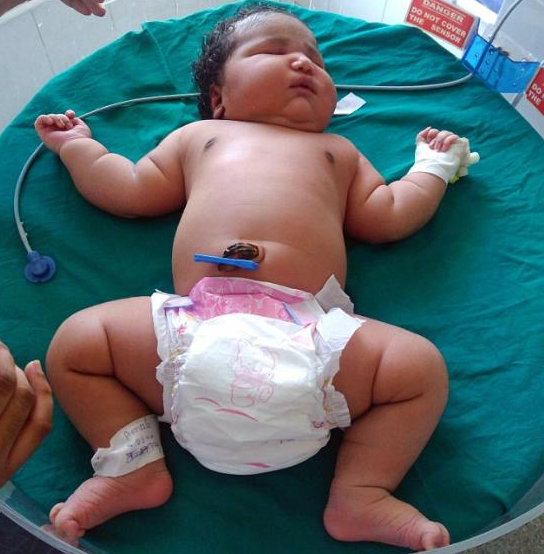 印度南部诞生一名女婴重达15磅