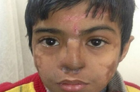 印度医生在一男童额头"种"鼻子 为其恢复容貌!