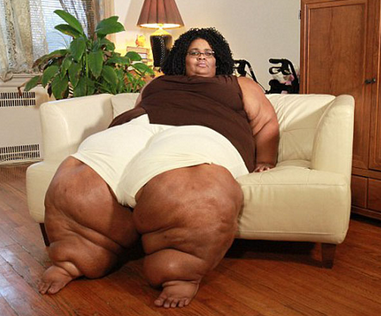 A woman in the U.S. suffers from a strange disease with legs as thick as an elephant and a waist circumference that is as large as an elephant’s diameter..jpg