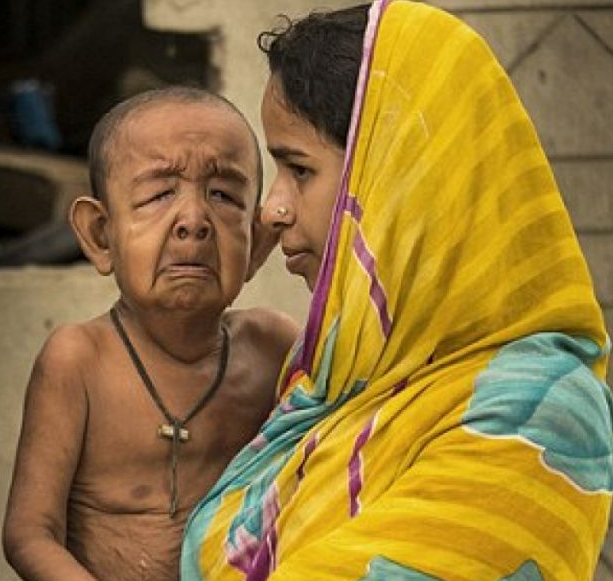 A 4-year-old boy in Bangladesh looks like an 80-year-old man.jpg