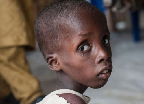 联合国儿童基金会 尼日利亚近25万儿童严重营养不良