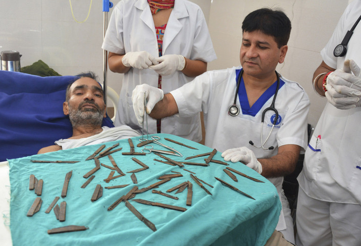 印度男子吃下40把刀 医生从胃中取出挽回生命