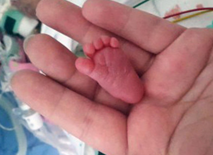 现实版拇指姑娘 世界最轻婴儿体重仅0.4斤