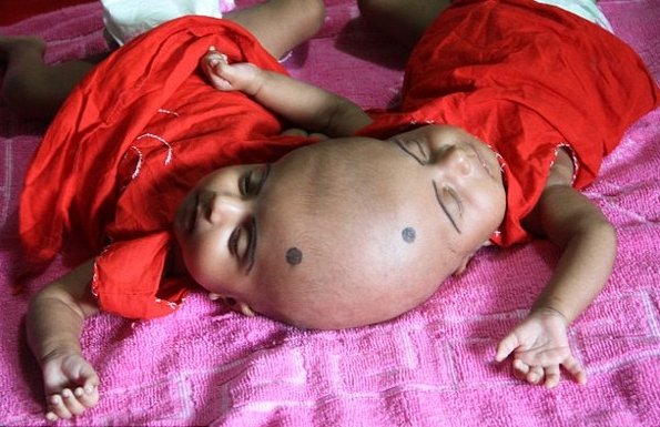 孟加拉国连体婴儿需等上2年才能进行手术