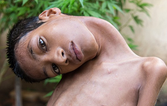 印度13岁男孩脖子极度弯曲 术后终可正常看世界