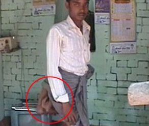 惊呆! 印度男子竟然有4条腿 网络求助做截肢手术!