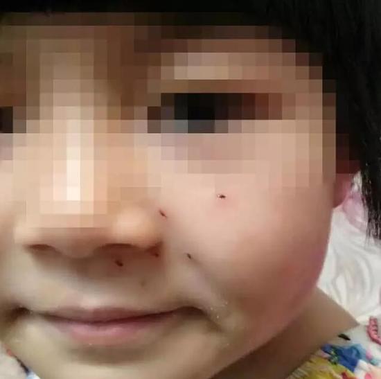 A 6-year-old girl who couldn't do the test got 6 holes in her face by the teacher of the training class! .jpg