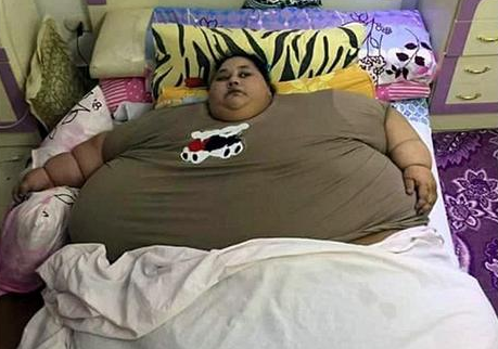 印度医生将为一名500公斤重的女子动手术