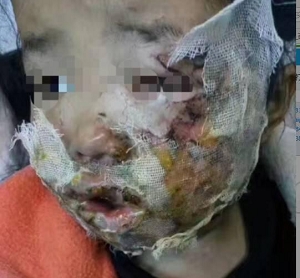 三星Note4手机爆炸 5岁女童脸部烧伤或毁容