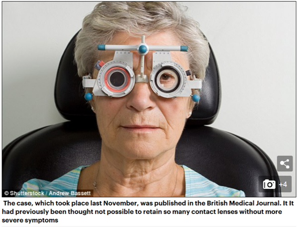 老妇眼睛不适就医，竟取出27枚隐形眼镜.jpg