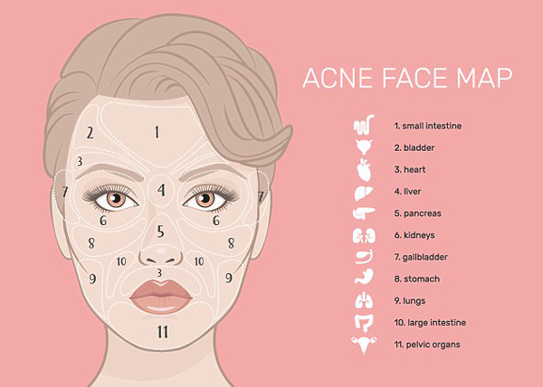 Why acne is a soft spot for you.jpg