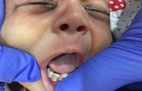 印度男婴一出生就有7颗牙 经两次手术全部拔除