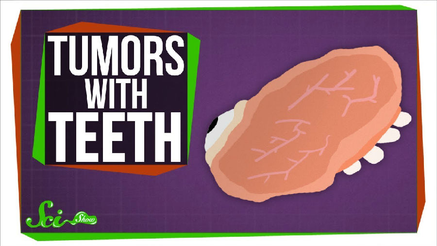 畸胎瘤:长有牙齿的肿瘤
