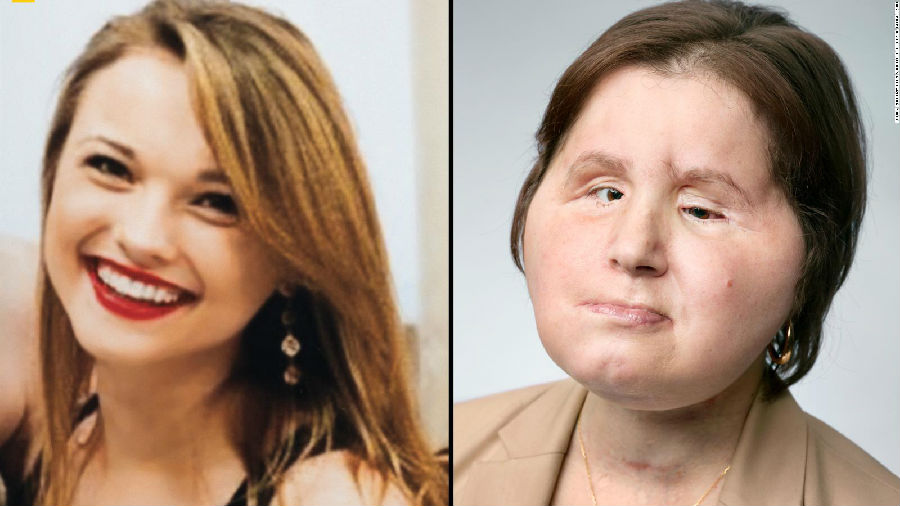 移植的脸如何改变了一名女子的生活
