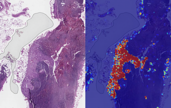 图：左侧为包含淋巴结的人体组织幻灯片，右侧为LYNA识别的肿瘤区.png