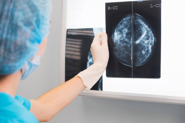 研究显示 定期筛查使乳腺癌死亡率有所下降